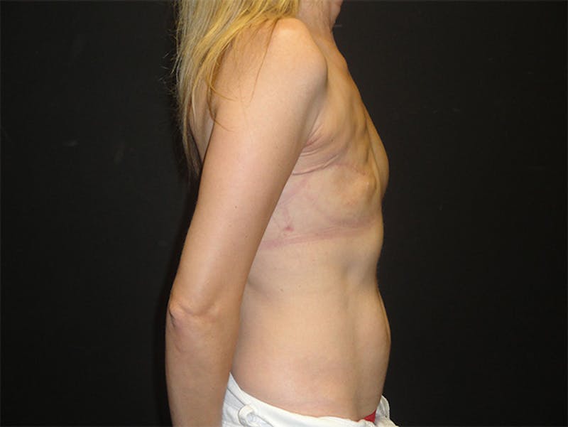 Breast Flap Reconstruction Before & After Gallery - Patient 167355666 - Image 5