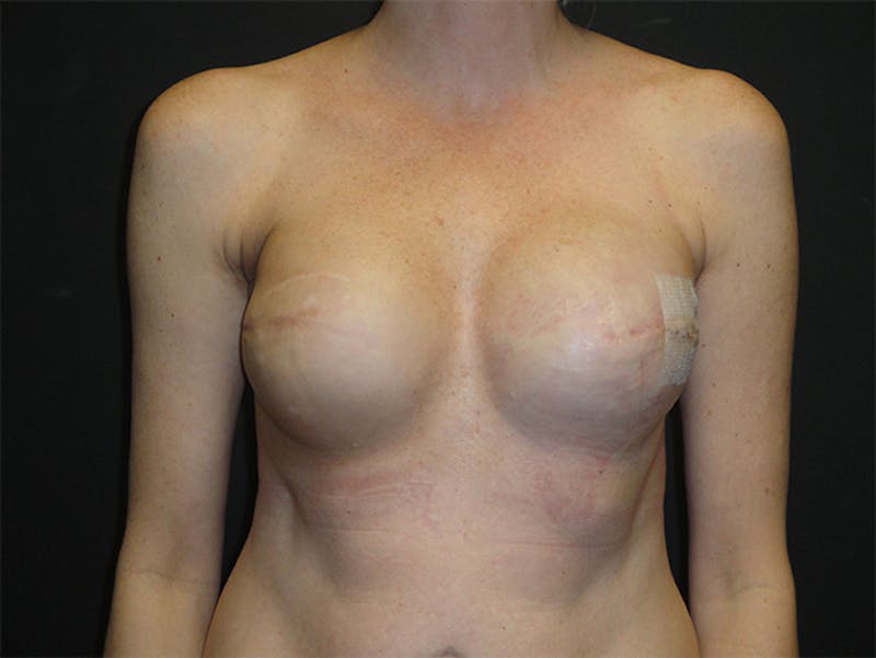 Breast Implant Reconstruction Before & After Gallery - Patient 167355676 - Image 2