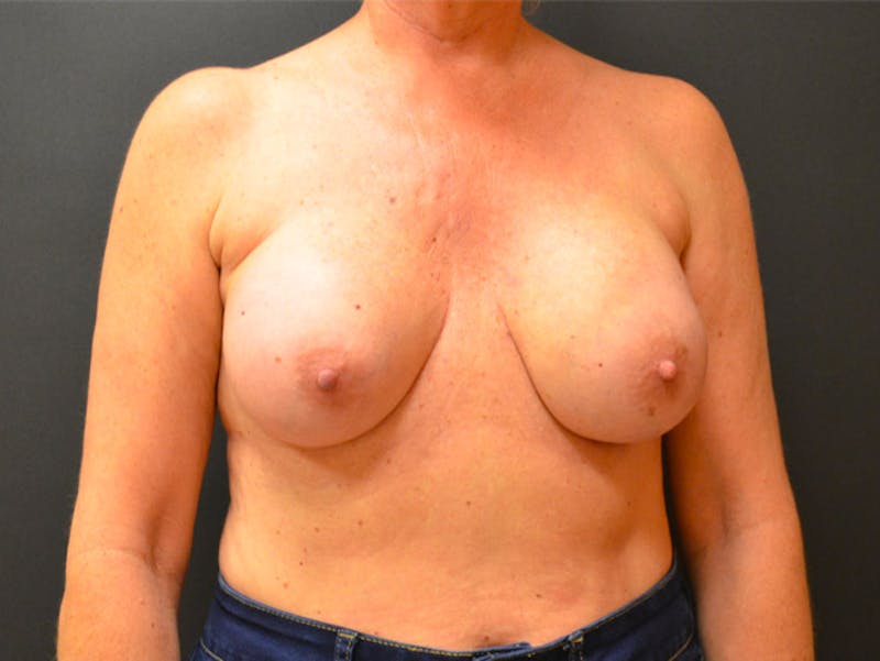 Breast Revision Before & After Gallery - Patient 167355675 - Image 1