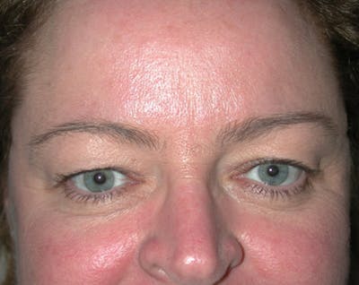 Eyelid Surgery Before & After Gallery - Patient 167355668 - Image 1