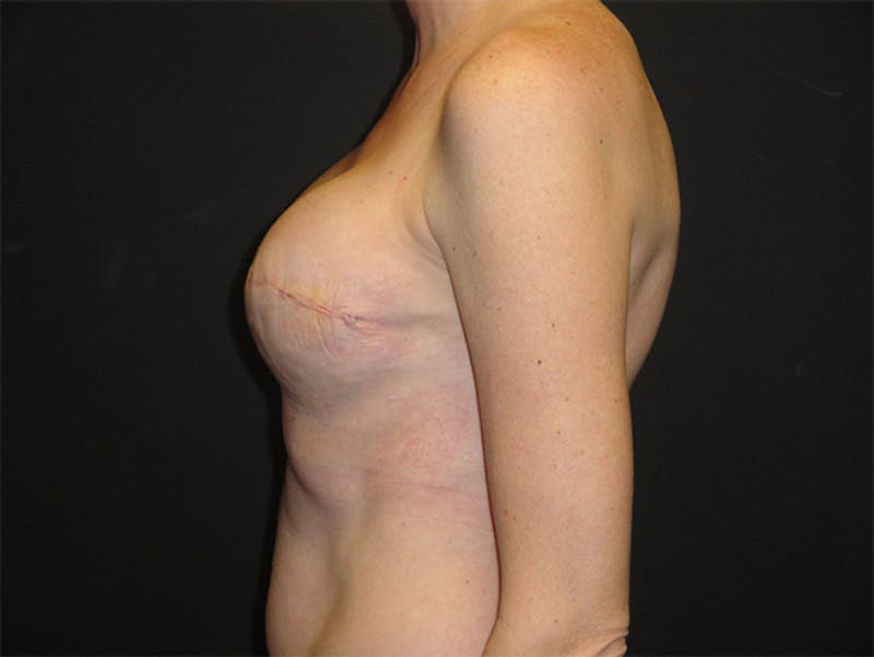 Breast Implant Reconstruction Before & After Gallery - Patient 167355676 - Image 4