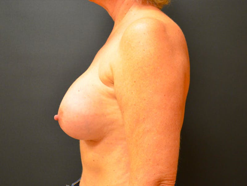 Breast Revision Before & After Gallery - Patient 167355675 - Image 3