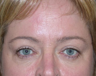 Eyelid Surgery Before & After Gallery - Patient 167355668 - Image 2