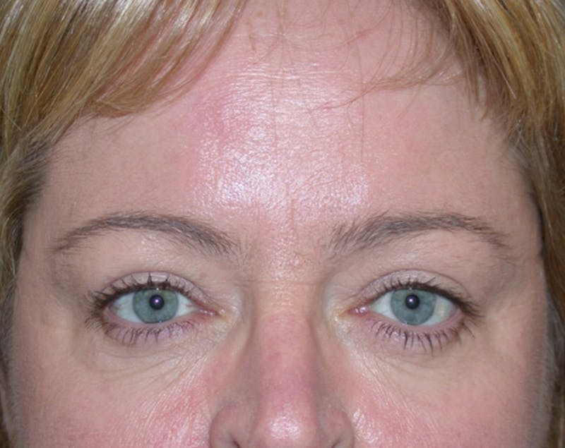Eyelid Surgery Before & After Gallery - Patient 167355668 - Image 2