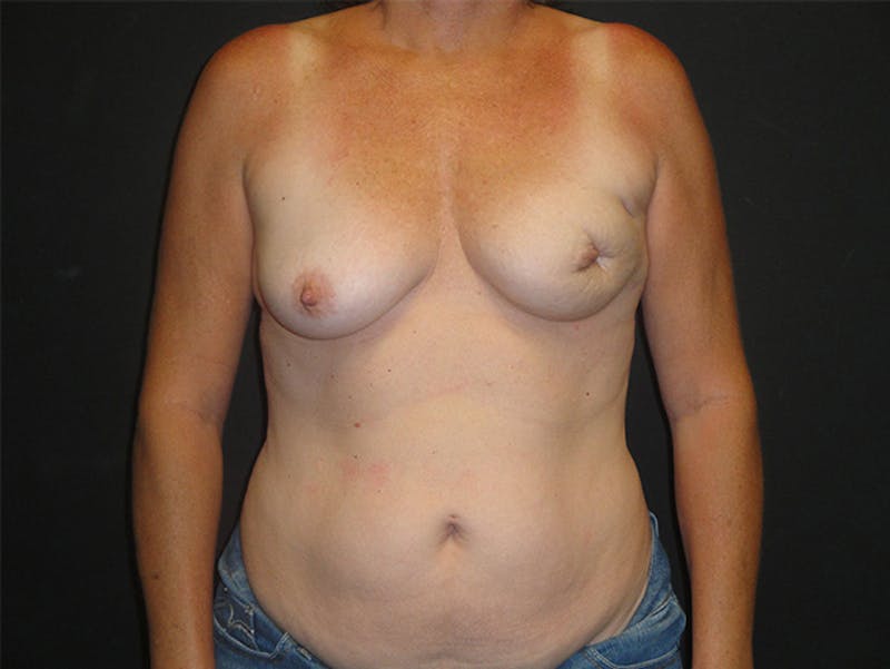 Breast Flap Reconstruction Before & After Gallery - Patient 167355683 - Image 1