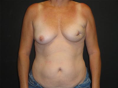 Breast Flap Reconstruction Before & After Gallery - Patient 167355683 - Image 1