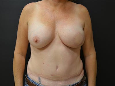 Breast Flap Reconstruction Before & After Gallery - Patient 167355683 - Image 2