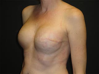Breast Implant Reconstruction Before & After Gallery - Patient 167355676 - Image 4