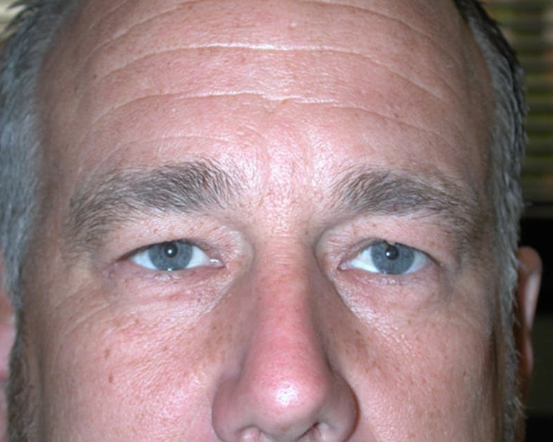 Eyelid Surgery Before & After Gallery - Patient 167355678 - Image 1