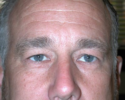 Eyelid Surgery Before & After Gallery - Patient 167355678 - Image 1