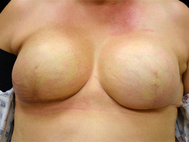 Nipple Correction Before & After Gallery - Patient 167355680 - Image 3
