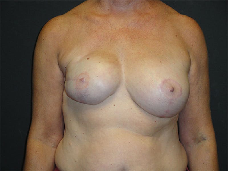 Breast Revision Before & After Gallery - Patient 167355698 - Image 1