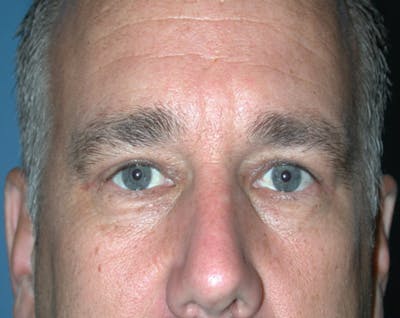 Eyelid Surgery Before & After Gallery - Patient 167355678 - Image 2