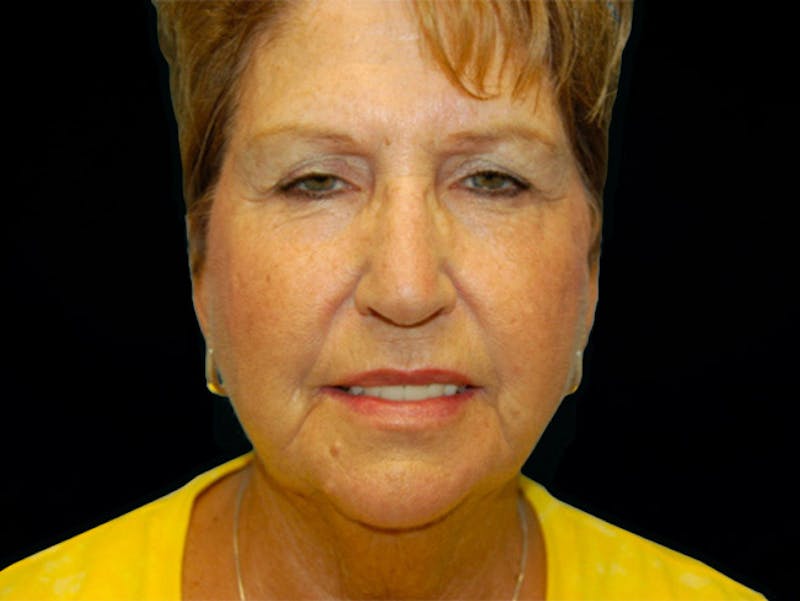Face Lift Before & After Gallery - Patient 167355693 - Image 1