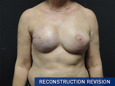 Breast Revision Before & After Gallery - Patient 167355698 - Image 2