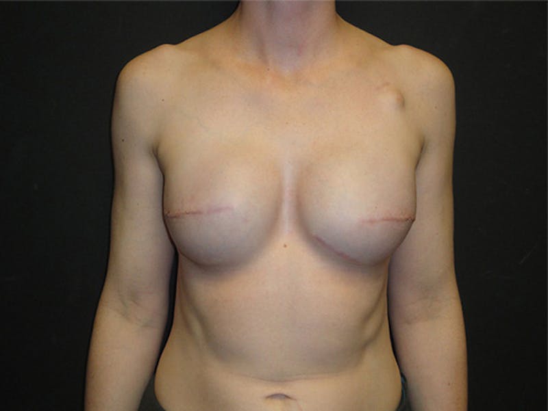 Breast Implant Reconstruction Before & After Gallery - Patient 167358250 - Image 2