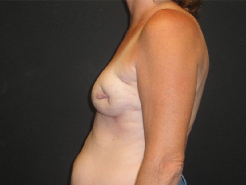 Breast Flap Reconstruction Before & After Gallery - Patient 167355683 - Image 5
