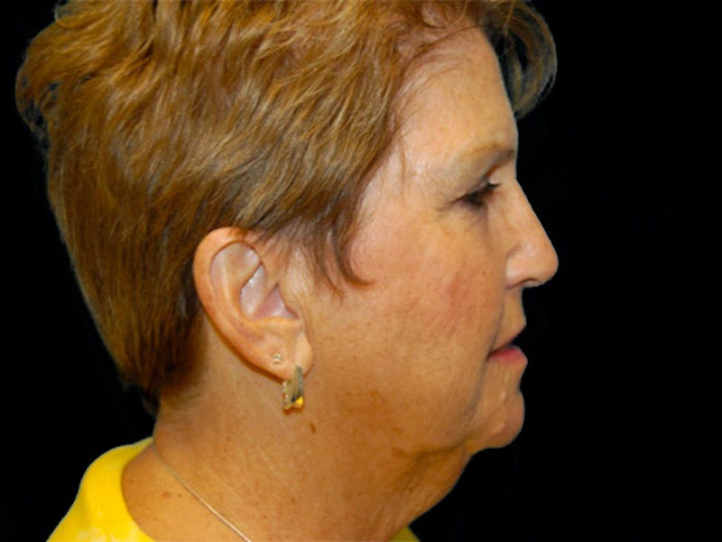 Face Lift Before & After Gallery - Patient 167355693 - Image 3
