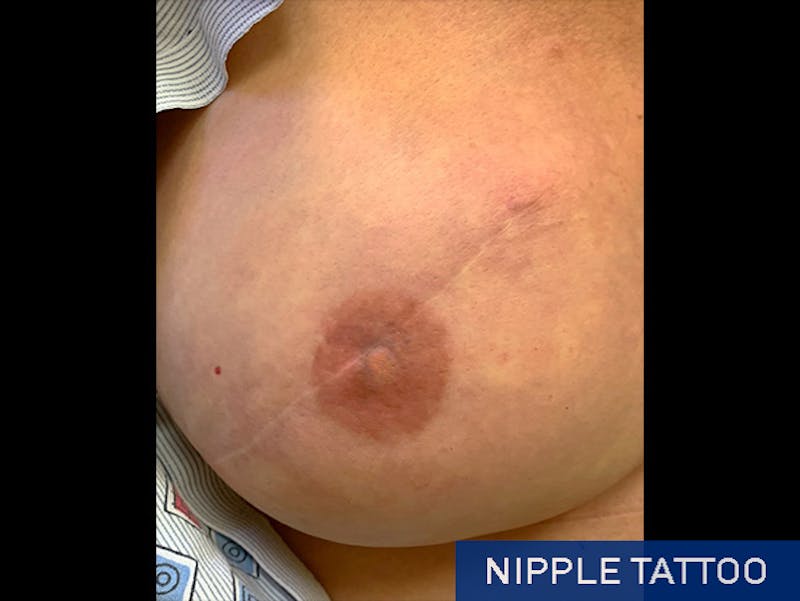 Nipple Correction Before & After Gallery - Patient 167355695 - Image 2