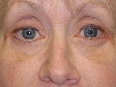 Eyelid Surgery Before & After Gallery - Patient 167355694 - Image 2