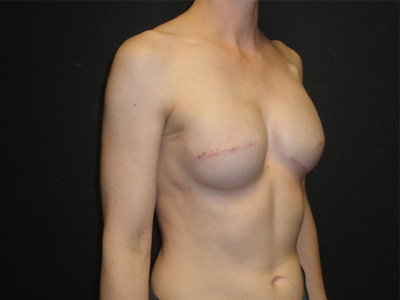 Breast Implant Reconstruction Before & After Gallery - Patient 167358250 - Image 4