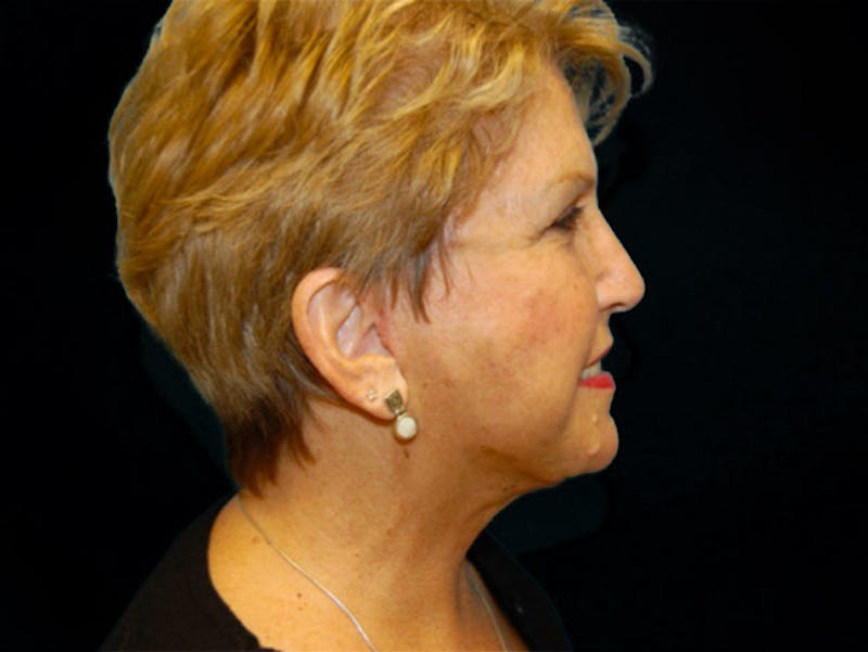 Face Lift Before & After Gallery - Patient 167355693 - Image 4