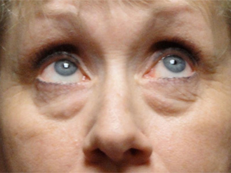 Eyelid Surgery Before & After Gallery - Patient 167355694 - Image 3