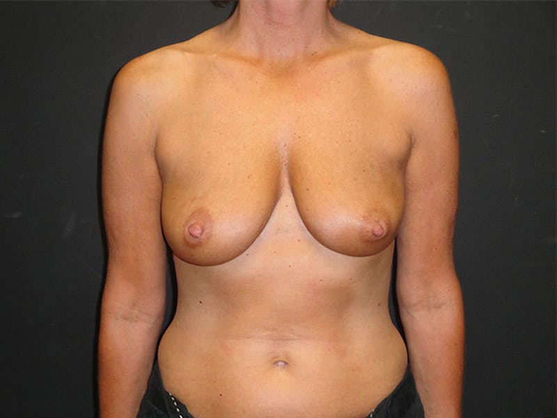 Breast Flap Reconstruction Before & After Gallery - Patient 167358256 - Image 1