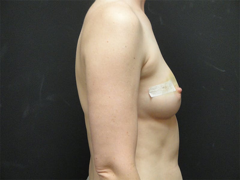 Breast Implant Reconstruction Before & After Gallery - Patient 167358250 - Image 5