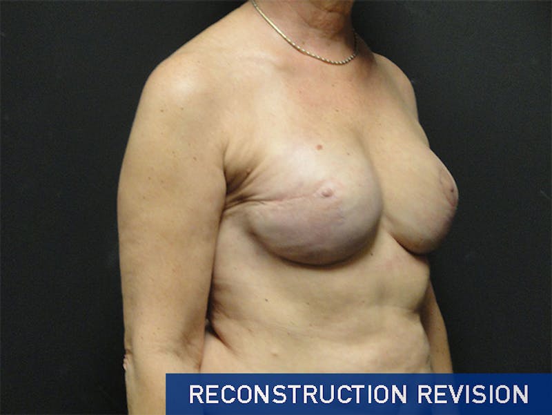 Breast Revision Before & After Gallery - Patient 167355698 - Image 4