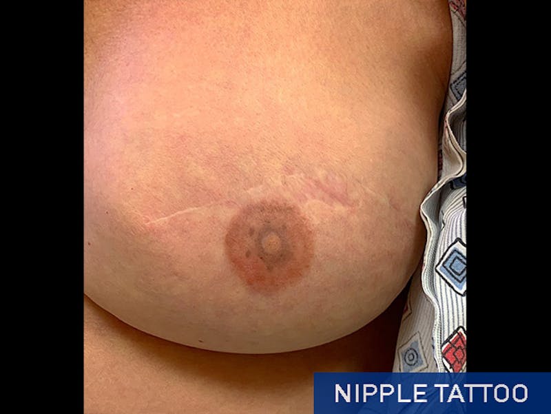Nipple Correction Before & After Gallery - Patient 167355695 - Image 4