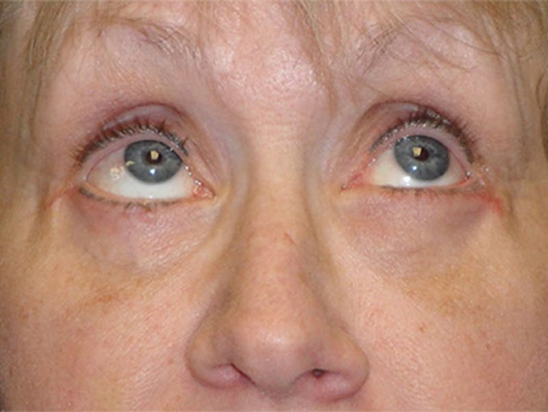 Eyelid Surgery Before & After Gallery - Patient 167355694 - Image 4