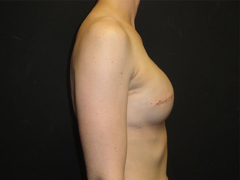 Breast Implant Reconstruction Before & After Gallery - Patient 167358250 - Image 6
