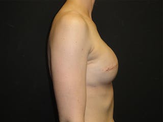 Breast Implant Reconstruction Before & After Gallery - Patient 167358250 - Image 6
