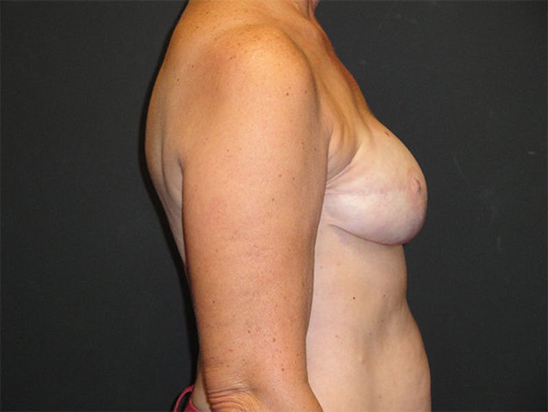 Breast Revision Before & After Gallery - Patient 167355698 - Image 5
