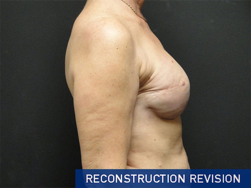 Breast Revision Before & After Gallery - Patient 167355698 - Image 6