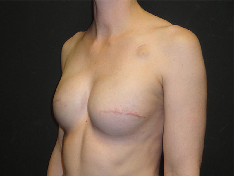 Breast Implant Reconstruction Before & After Gallery - Patient 167358250 - Image 8