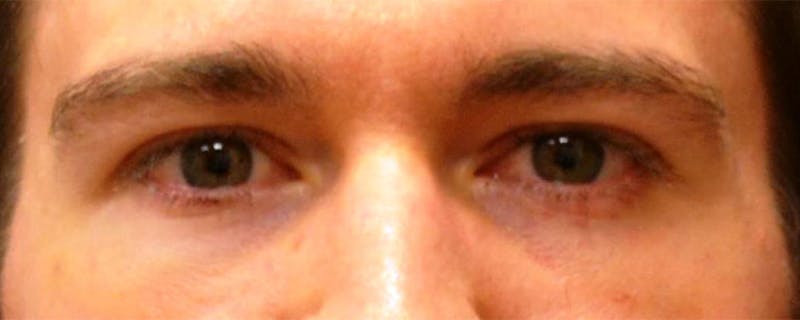 Eyelid Surgery Before & After Gallery - Patient 167358254 - Image 2