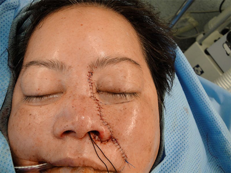 Face Reconstruction Before & After Gallery - Patient 167358252 - Image 2