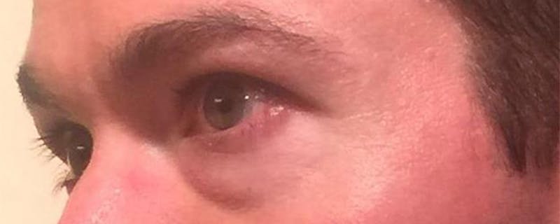Eyelid Surgery Before & After Gallery - Patient 167358254 - Image 3