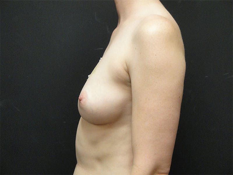 Breast Implant Reconstruction Before & After Gallery - Patient 167358250 - Image 9