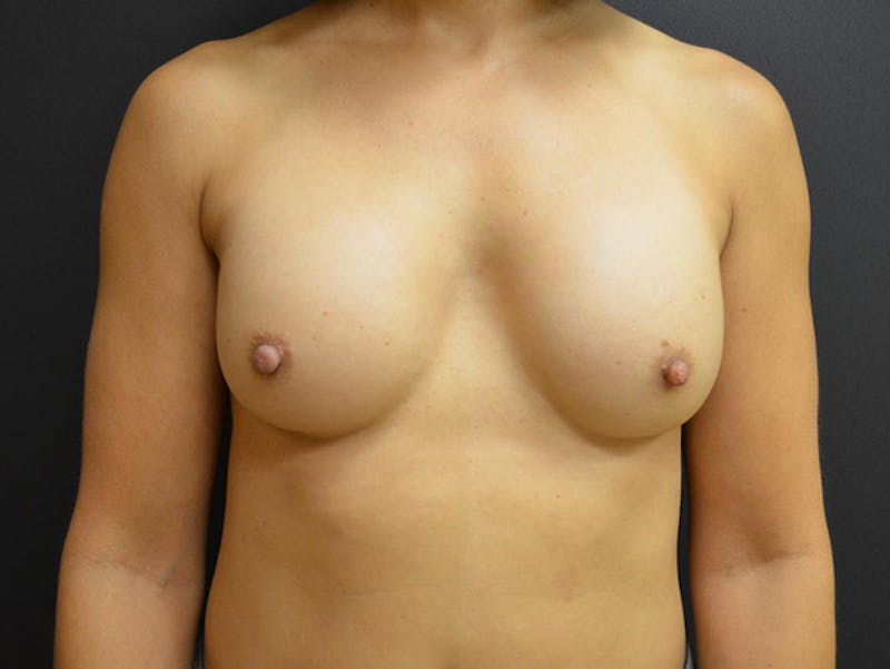 Breast Revision Before & After Gallery - Patient 167358251 - Image 1