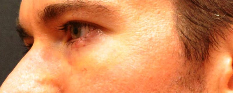 Eyelid Surgery Before & After Gallery - Patient 167358254 - Image 4