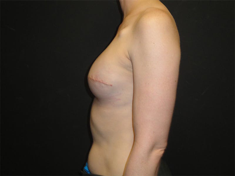 Breast Implant Reconstruction Before & After Gallery - Patient 167358250 - Image 10