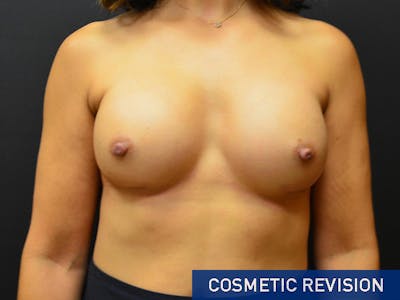 Breast Revision Before & After Gallery - Patient 167358251 - Image 2