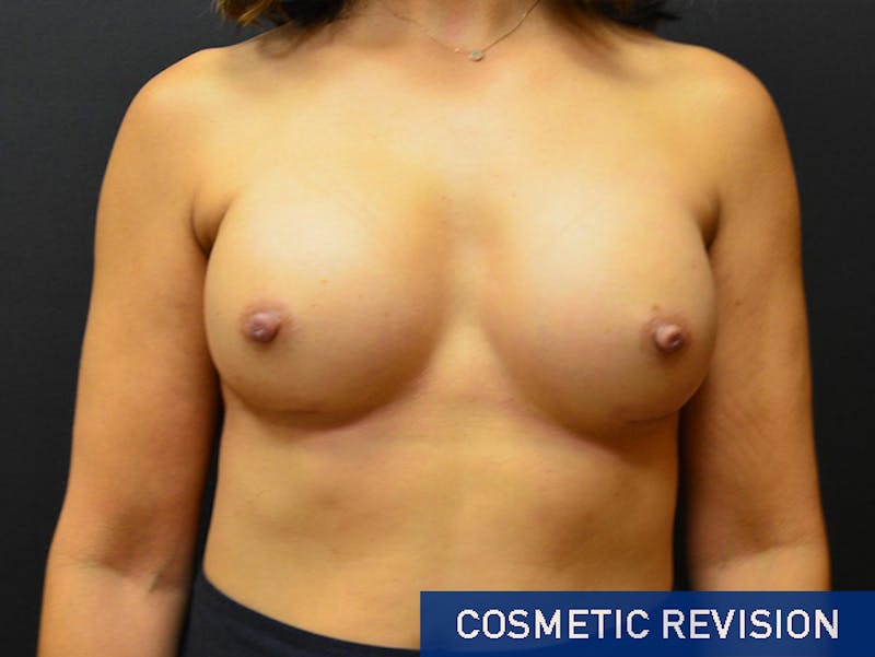 Breast Revision Before & After Gallery - Patient 167358251 - Image 2