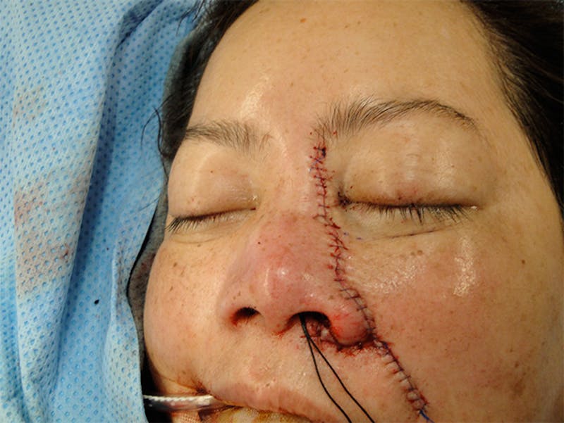 Reconstruction Before & After Gallery - Patient 167358252 - Image 4