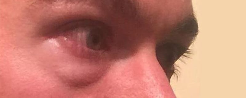 Eyelid Surgery Before & After Gallery - Patient 167358254 - Image 5
