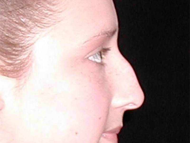 Rhinoplasty Before & After Gallery - Patient 167358258 - Image 1