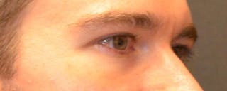 Eyelid Surgery Before & After Gallery - Patient 167358254 - Image 6